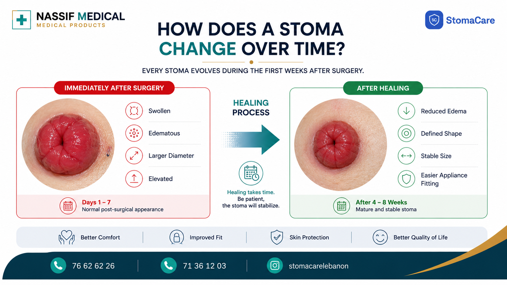 How a stoma changes over time