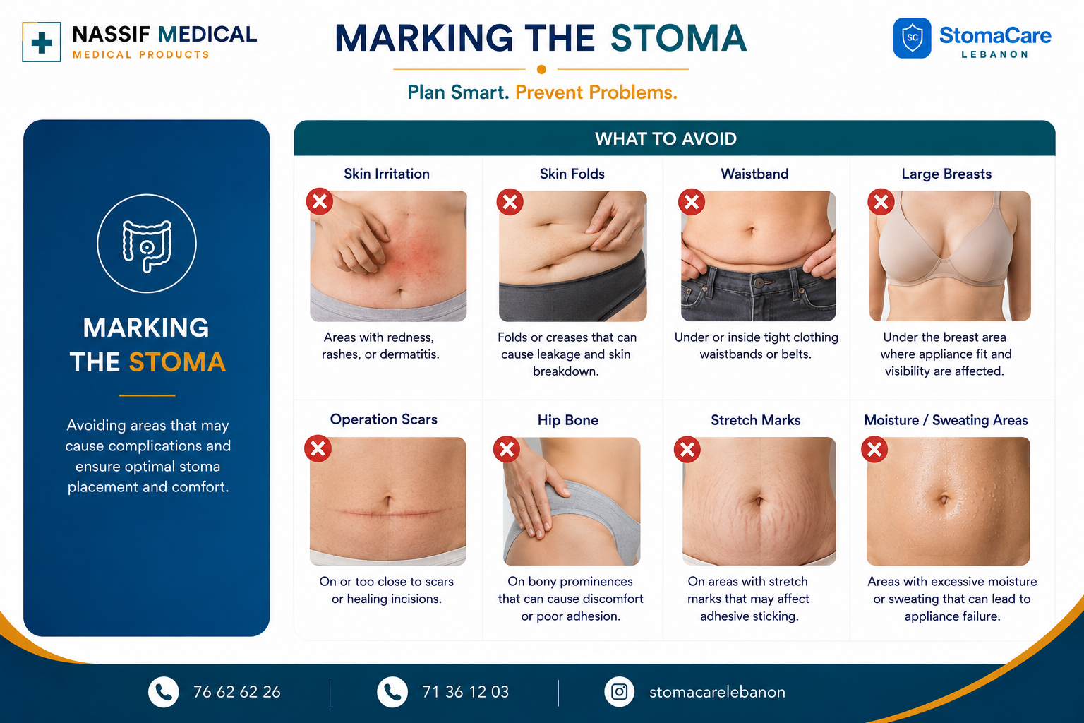 Marking the stoma