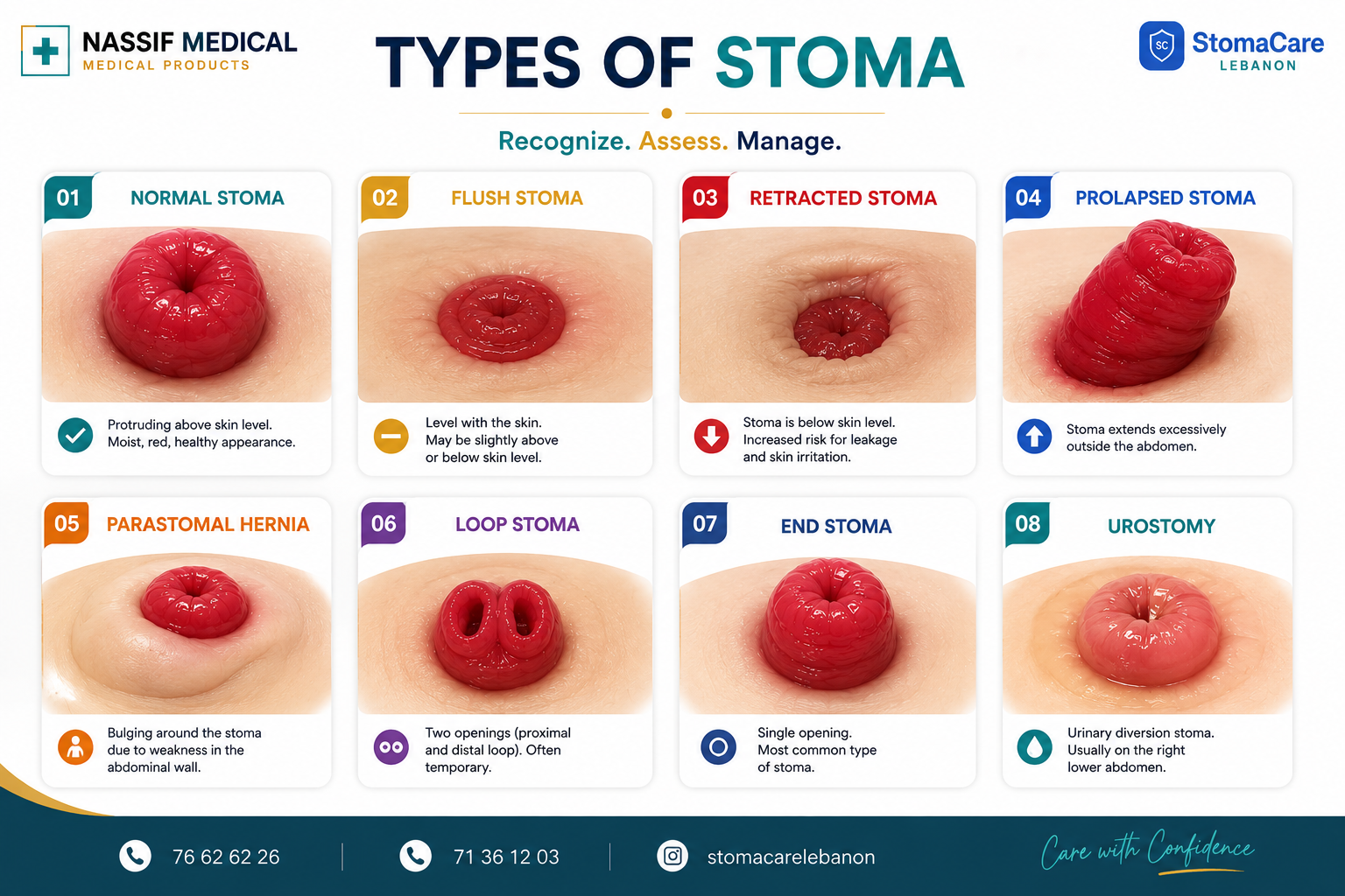 Types of stoma