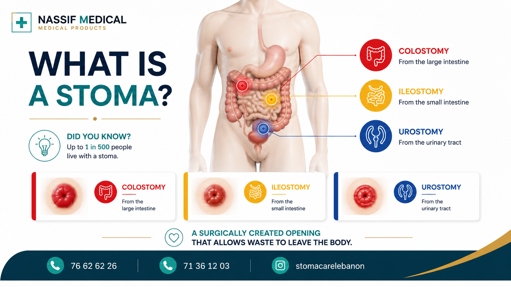 What is a stoma